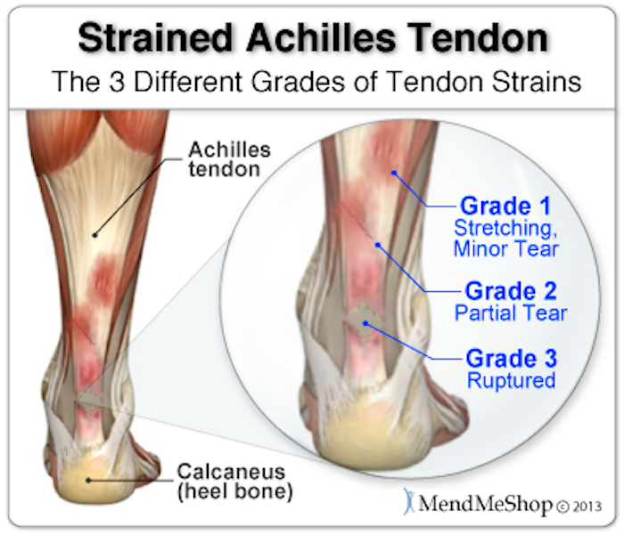 Achilles tendon injuries and running - Read Performance Training